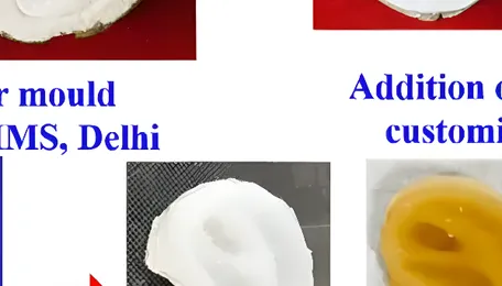 Engineering resilient prosthetics for India’s tropical heat 